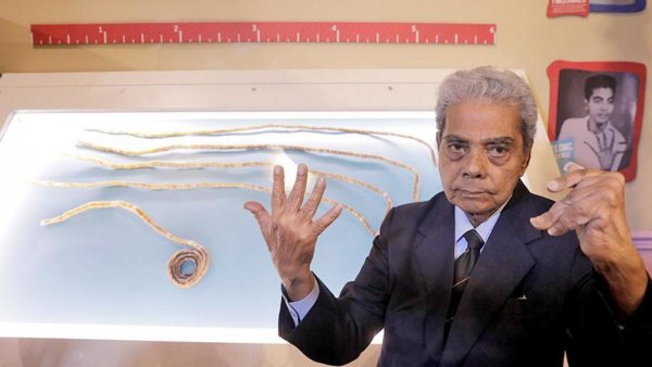 Индиец обрезал самые длинные ногти в мире после 66 лет отращивания