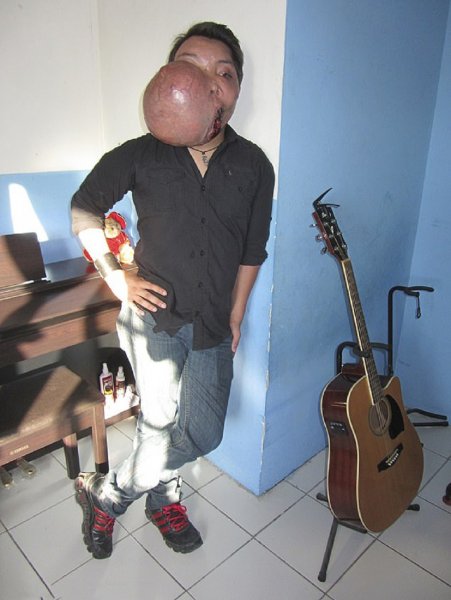 Мексиканскому музыканту удалили опухоль размером с мяч с помощью молотка и зубила